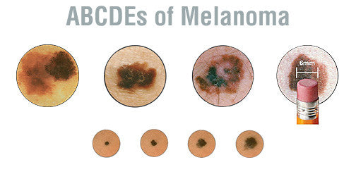 Melanoma Symptoms and Detection
