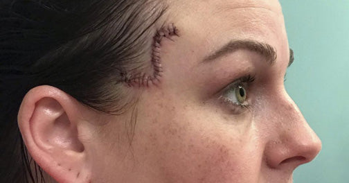 Mother Mistakes Skin Cancer for Blemish