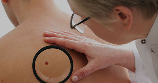 Researchers are Close to Melanoma Cure
