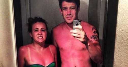 5 Weird Sunburn Locations