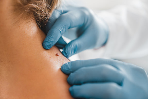 Melanoma: What You Need to Know